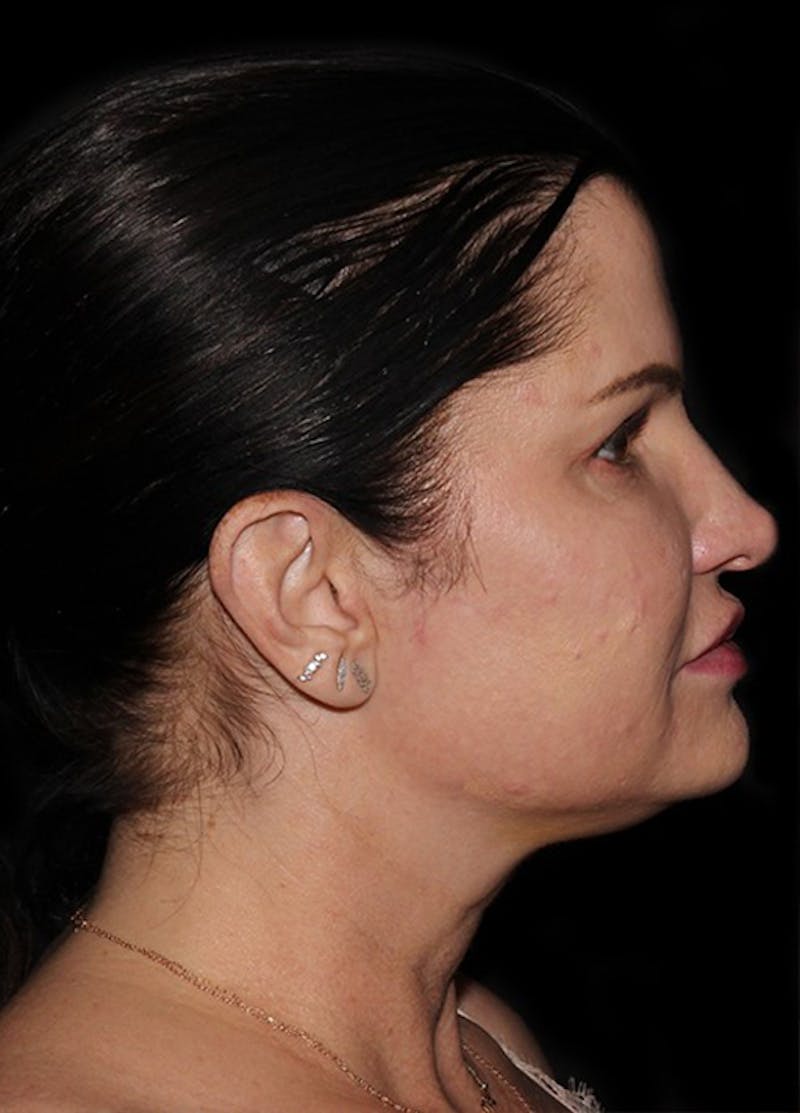 Facelift & Necklift Before & After Gallery - Patient 133024066 - Image 5