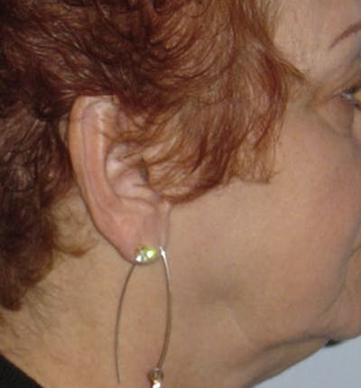 Facelift Scar Before & After Gallery - Patient 133024067 - Image 1