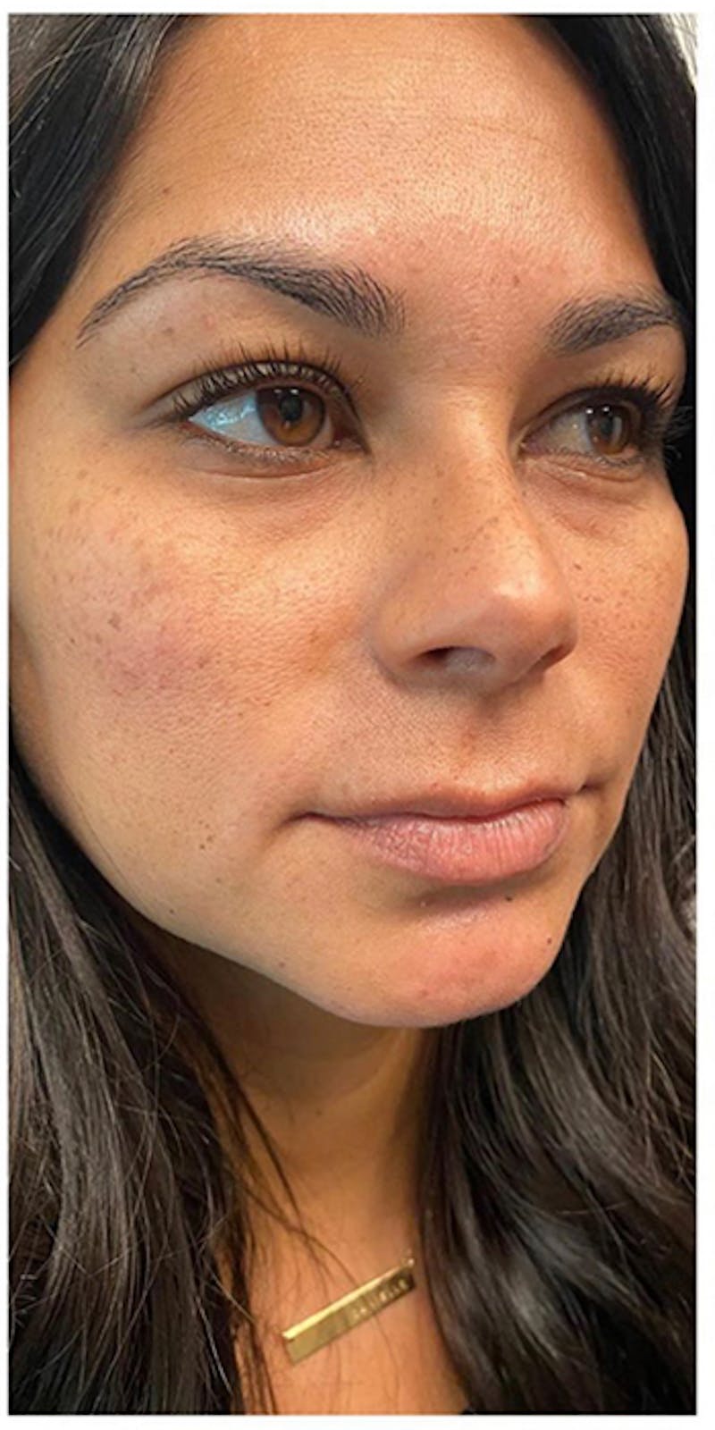 Dermal Fillers Before & After Gallery - Patient 133024070 - Image 5