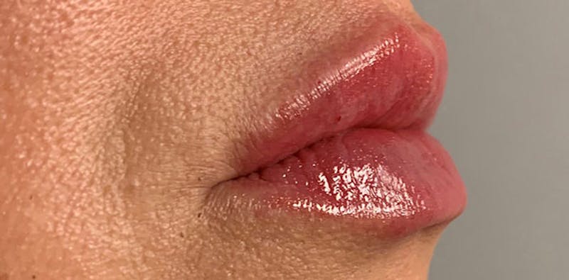 Lip Enhancement Before & After Gallery - Patient 133024063 - Image 6
