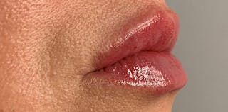 Lip Enhancement Before & After Gallery - Patient 133024063 - Image 6