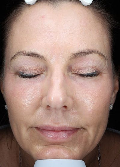 Halo Laser Before & After Gallery - Patient 133024080 - Image 2