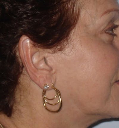 Facelift Scar Before & After Gallery - Patient 133024067 - Image 2