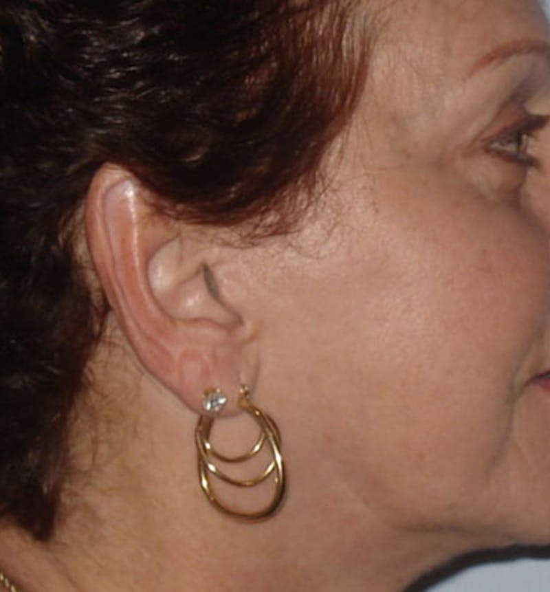 Facelift Scar Before & After Gallery - Patient 133024067 - Image 2