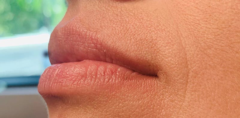 Lip Enhancement Before & After Gallery - Patient 133024069 - Image 1