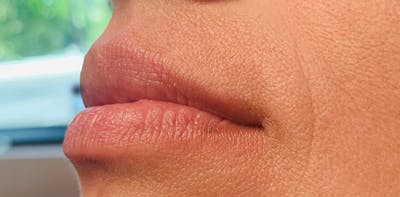 Lip Enhancement Before & After Gallery - Patient 133024069 - Image 1