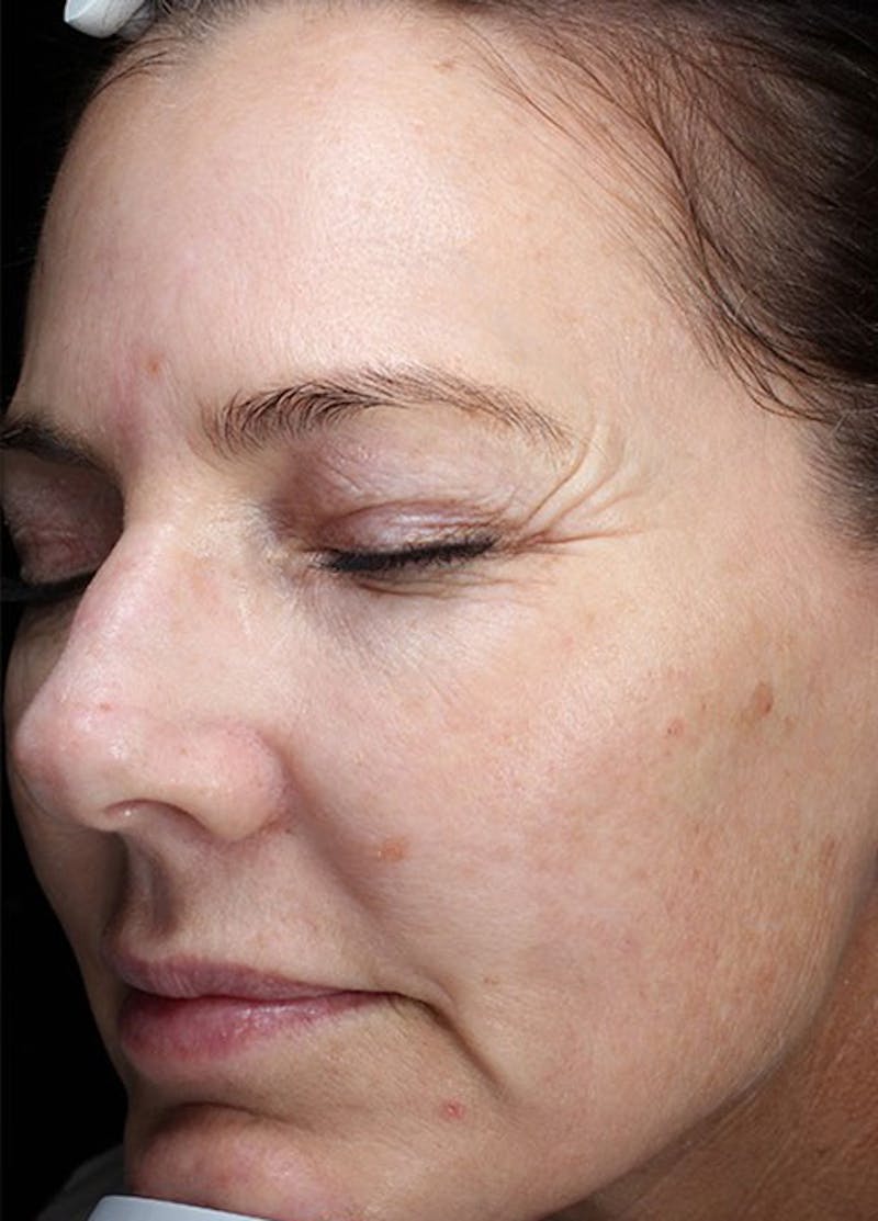 Halo Laser Before & After Gallery - Patient 133024080 - Image 3