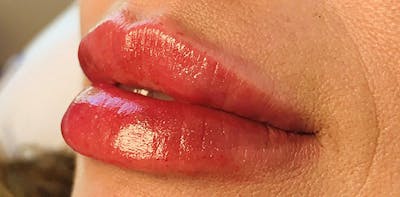 Lip Enhancement Before & After Gallery - Patient 133024069 - Image 2