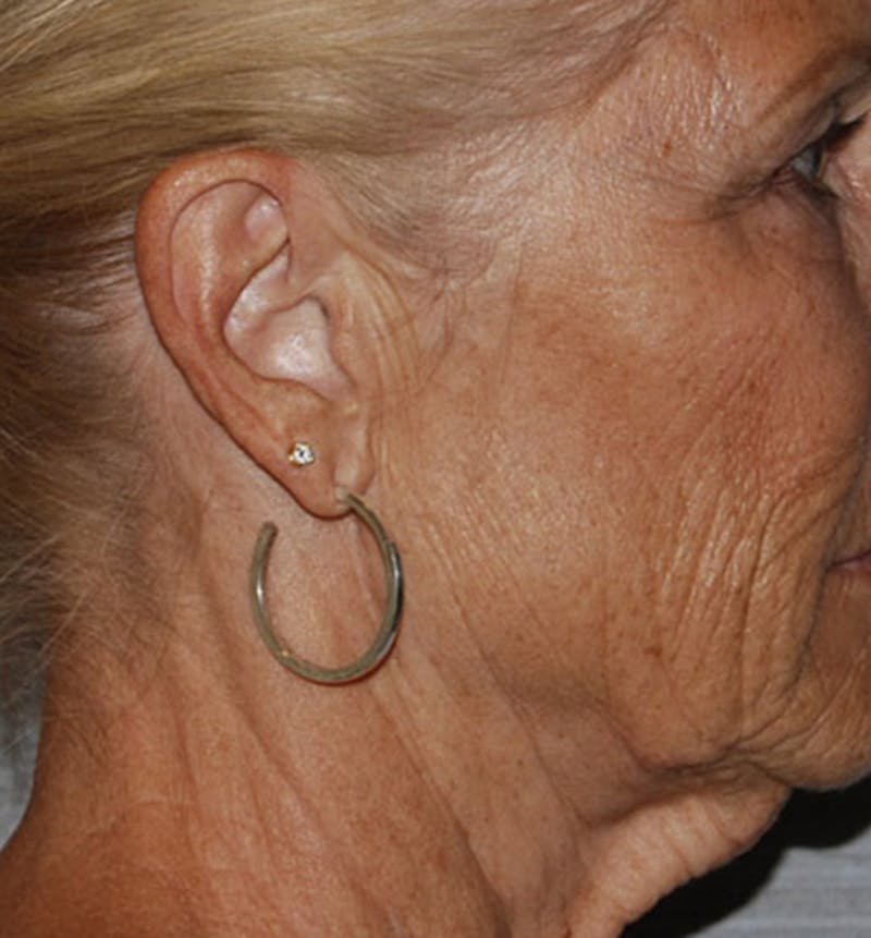 Facelift Scar Before & After Gallery - Patient 133024068 - Image 1