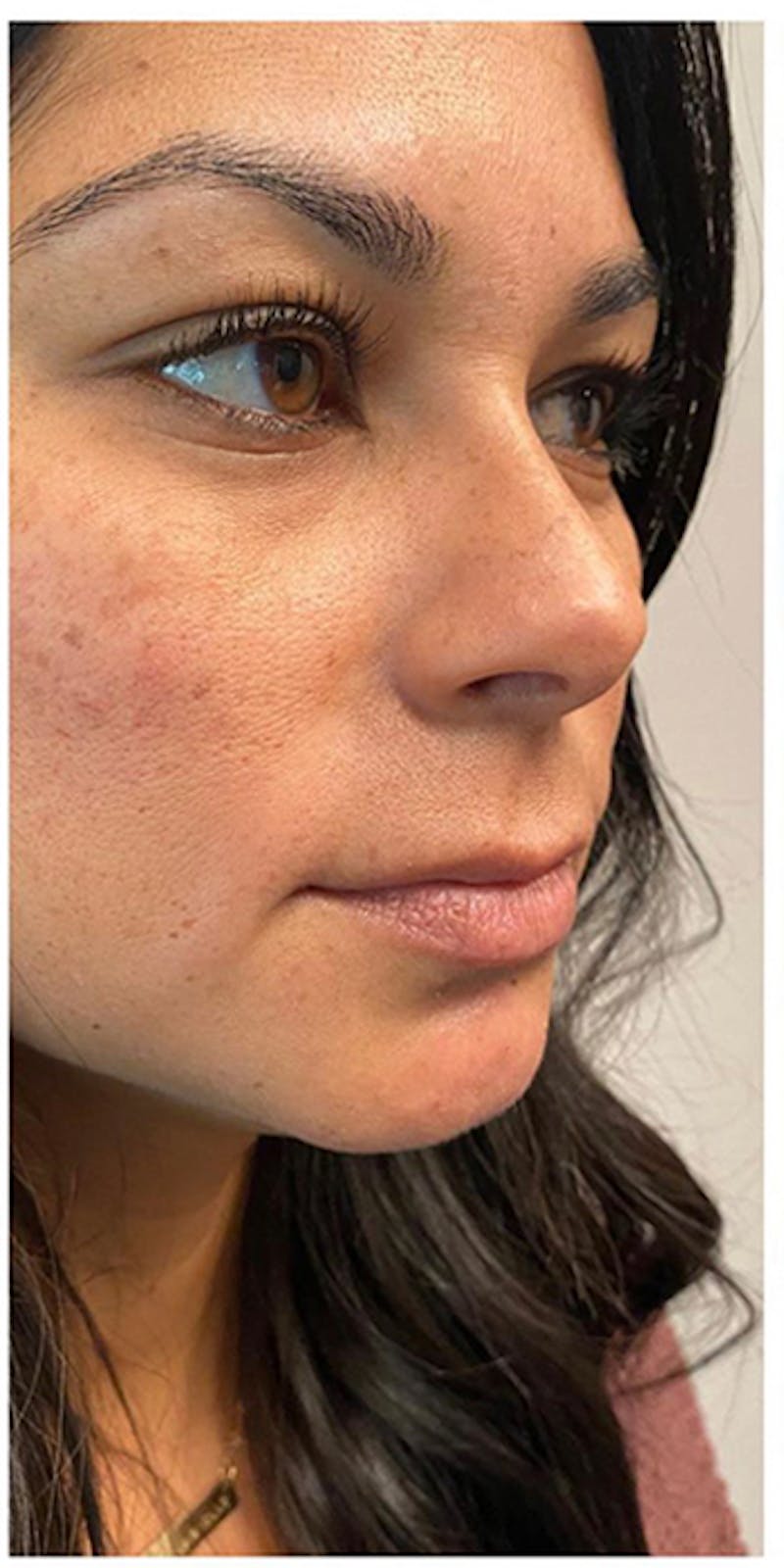 Dermal Fillers Before & After Gallery - Patient 133024070 - Image 7