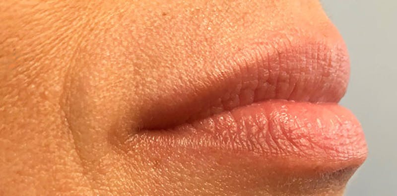 Lip Enhancement Before & After Gallery - Patient 133024069 - Image 3