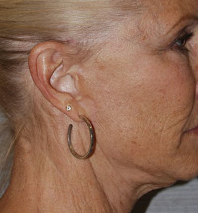 Facelift Scar Before & After Gallery - Patient 133024068 - Image 2