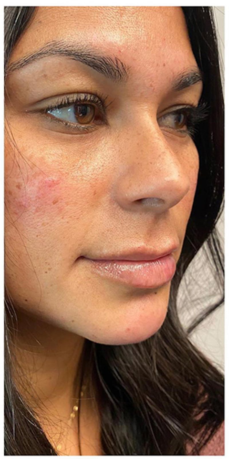 Dermal Fillers Before & After Gallery - Patient 133024070 - Image 8