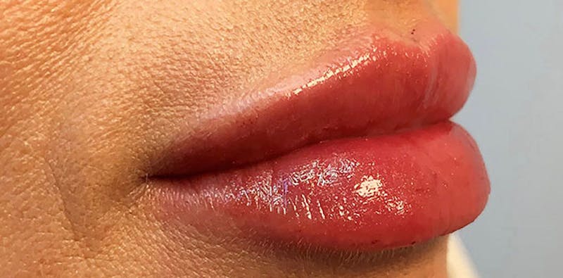 Lip Enhancement Before & After Gallery - Patient 133024069 - Image 4