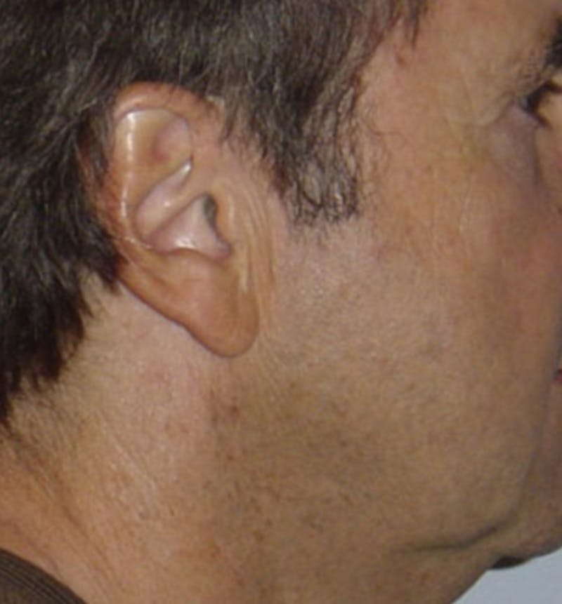 Facelift Scar Before & After Gallery - Patient 133024072 - Image 1