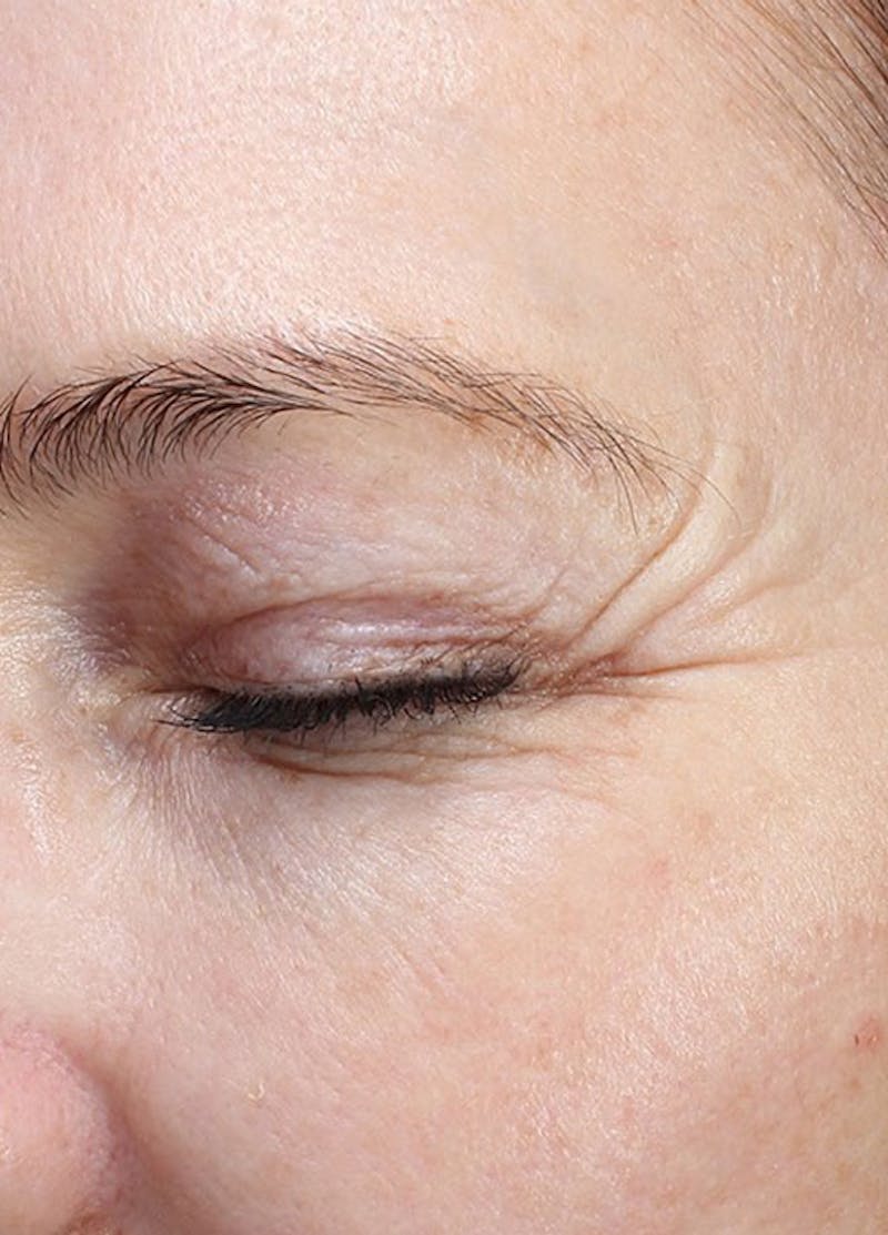 Halo Laser Before & After Gallery - Patient 133024080 - Image 7