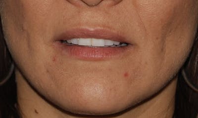 Lip Enhancement Before & After Gallery - Patient 133024073 - Image 1