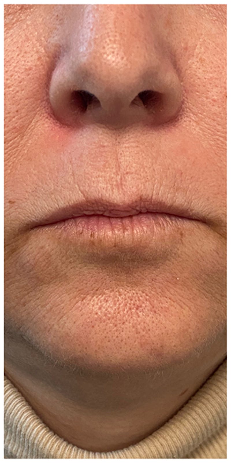 Dermal Fillers Before & After Gallery - Patient 133024098 - Image 1