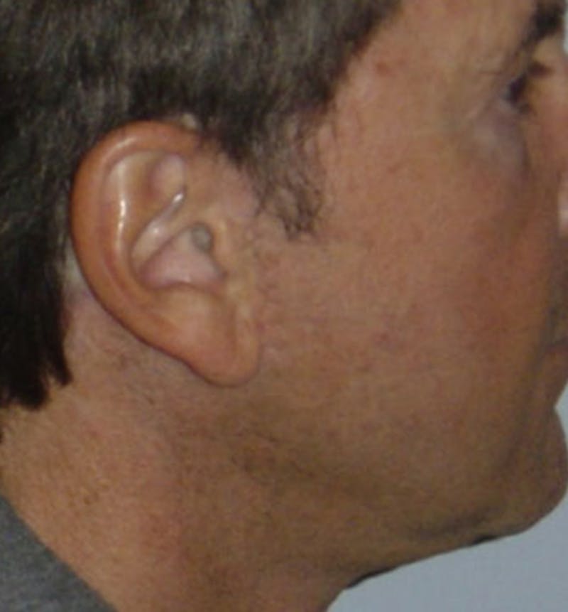 Facelift Scar Before & After Gallery - Patient 133024072 - Image 2