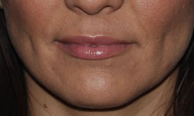 Lip Enhancement Before & After Gallery - Patient 133024073 - Image 2