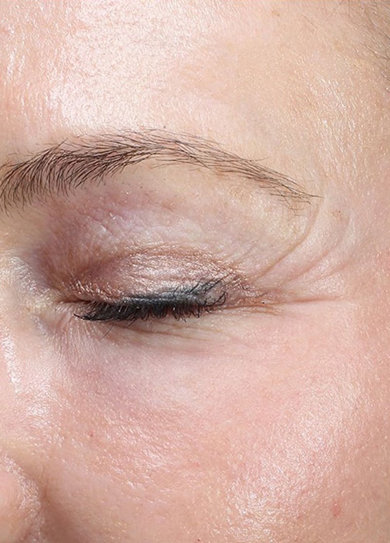 Halo Laser Before & After Gallery - Patient 133024080 - Image 8