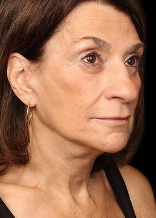 Facelift & Necklift Before & After Gallery - Patient 133024081 - Image 4