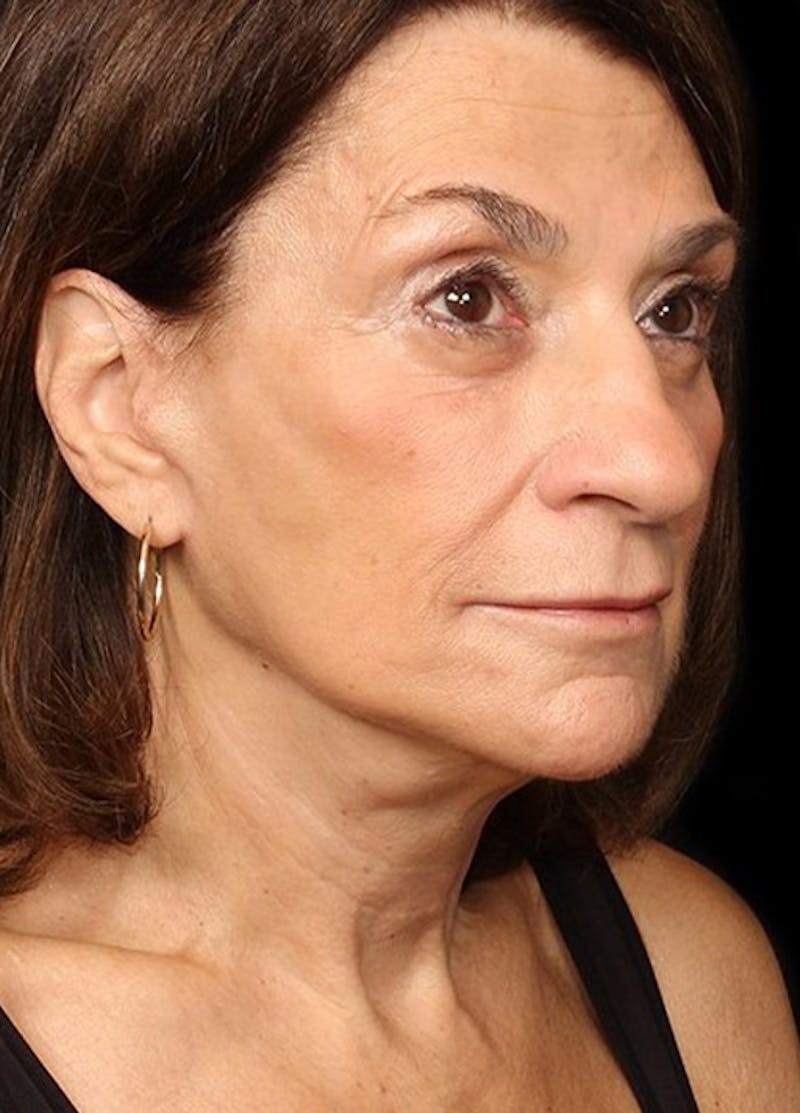 Facelift & Necklift Before & After Gallery - Patient 133024081 - Image 4
