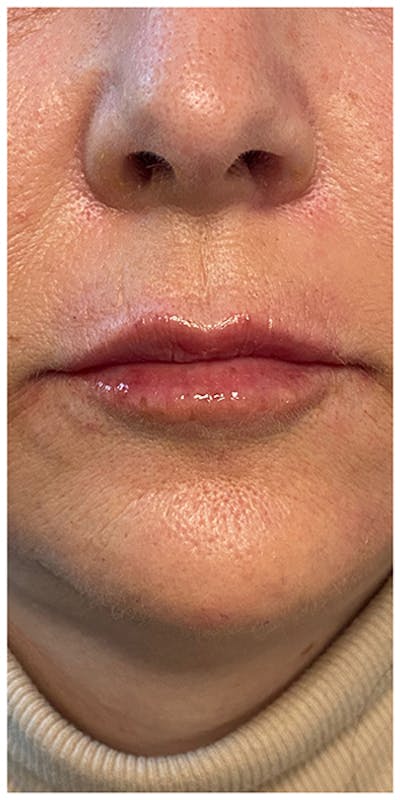 Dermal Fillers Before & After Gallery - Patient 133024098 - Image 2