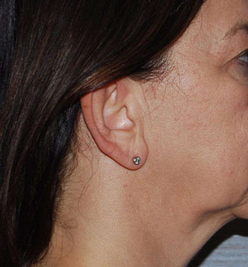 Facelift Scar Before & After Gallery - Patient 133024079 - Image 1