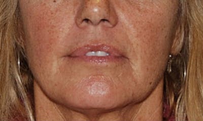 Lip Enhancement Before & After Gallery - Patient 133024084 - Image 1