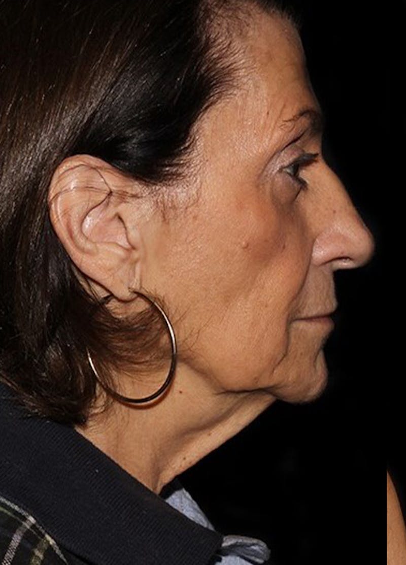 Facelift & Necklift Before & After Gallery - Patient 133024081 - Image 5