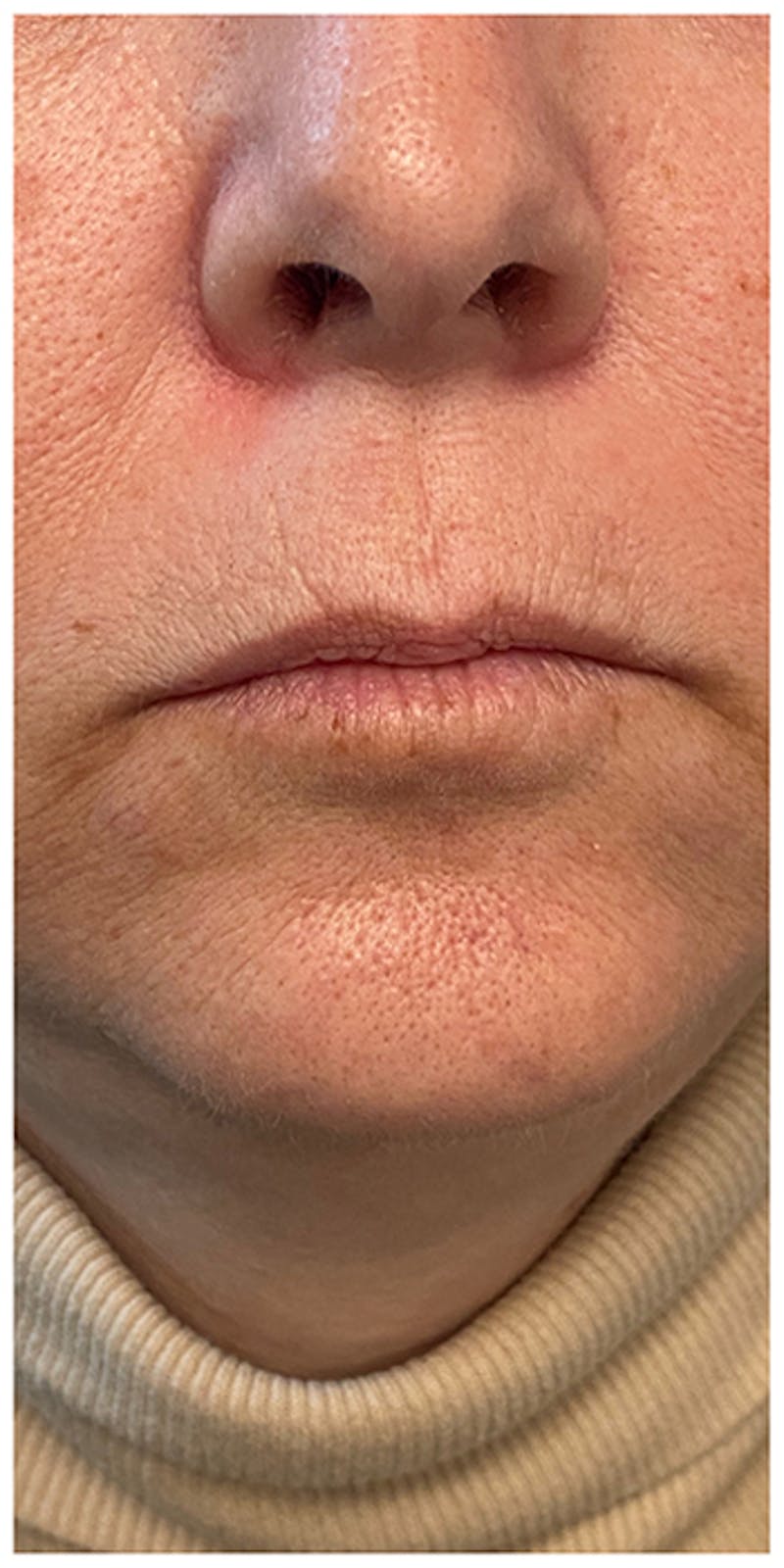 Dermal Fillers Before & After Gallery - Patient 133024098 - Image 3