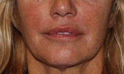 Lip Enhancement Before & After Gallery - Patient 133024084 - Image 2