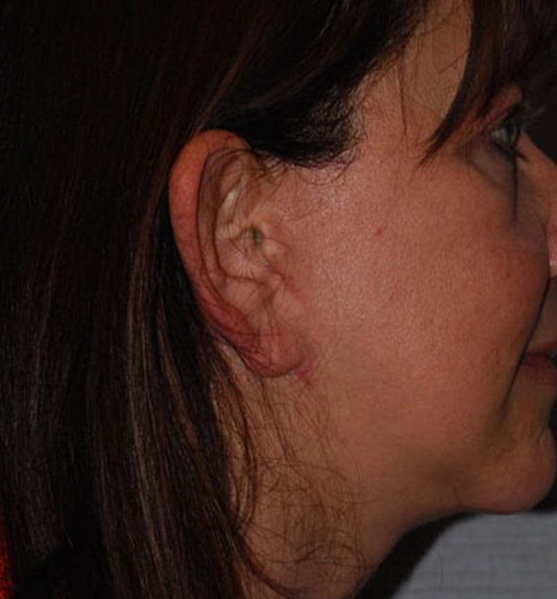 Facelift Scar Before & After Gallery - Patient 133024079 - Image 2