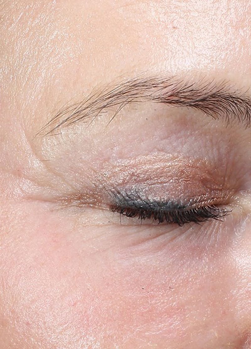 Halo Laser Before & After Gallery - Patient 133024080 - Image 10