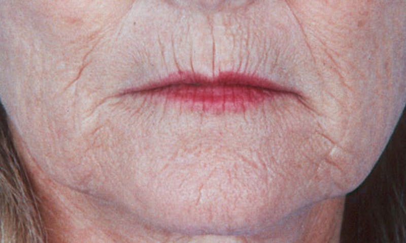 Laser Resurfacing Before & After Gallery - Patient 133024083 - Image 1