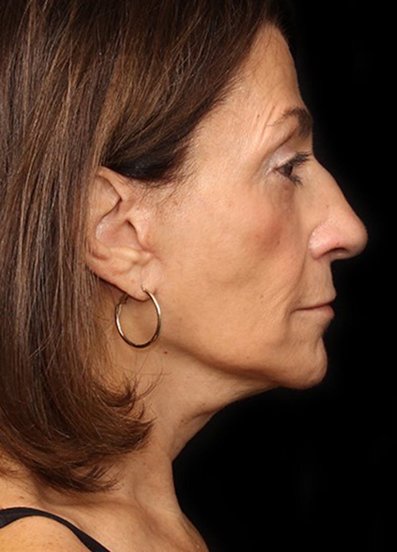 Facelift & Necklift Before & After Gallery - Patient 133024081 - Image 6