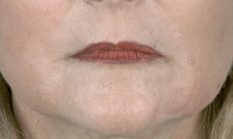 Laser Resurfacing Before & After Gallery - Patient 133024083 - Image 2