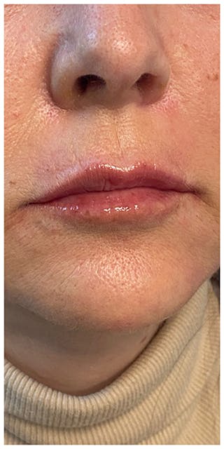 Dermal Fillers Before & After Gallery - Patient 133024098 - Image 4