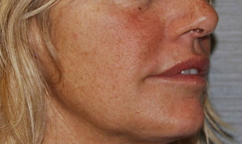 Lip Enhancement Before & After Gallery - Patient 133024084 - Image 4