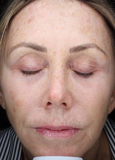 Halo Laser Before & After Gallery - Patient 133024088 - Image 1