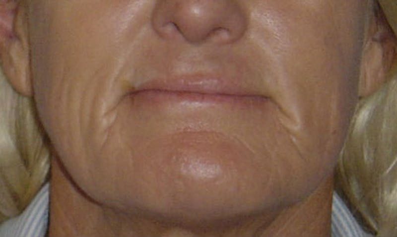 Laser Resurfacing Before & After Gallery - Patient 133024087 - Image 1