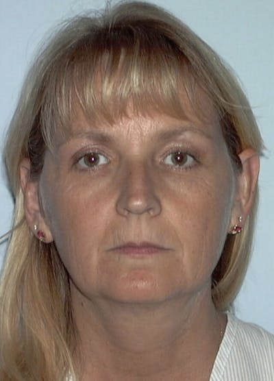 Facelift & Necklift Before & After Gallery - Patient 133024095 - Image 1