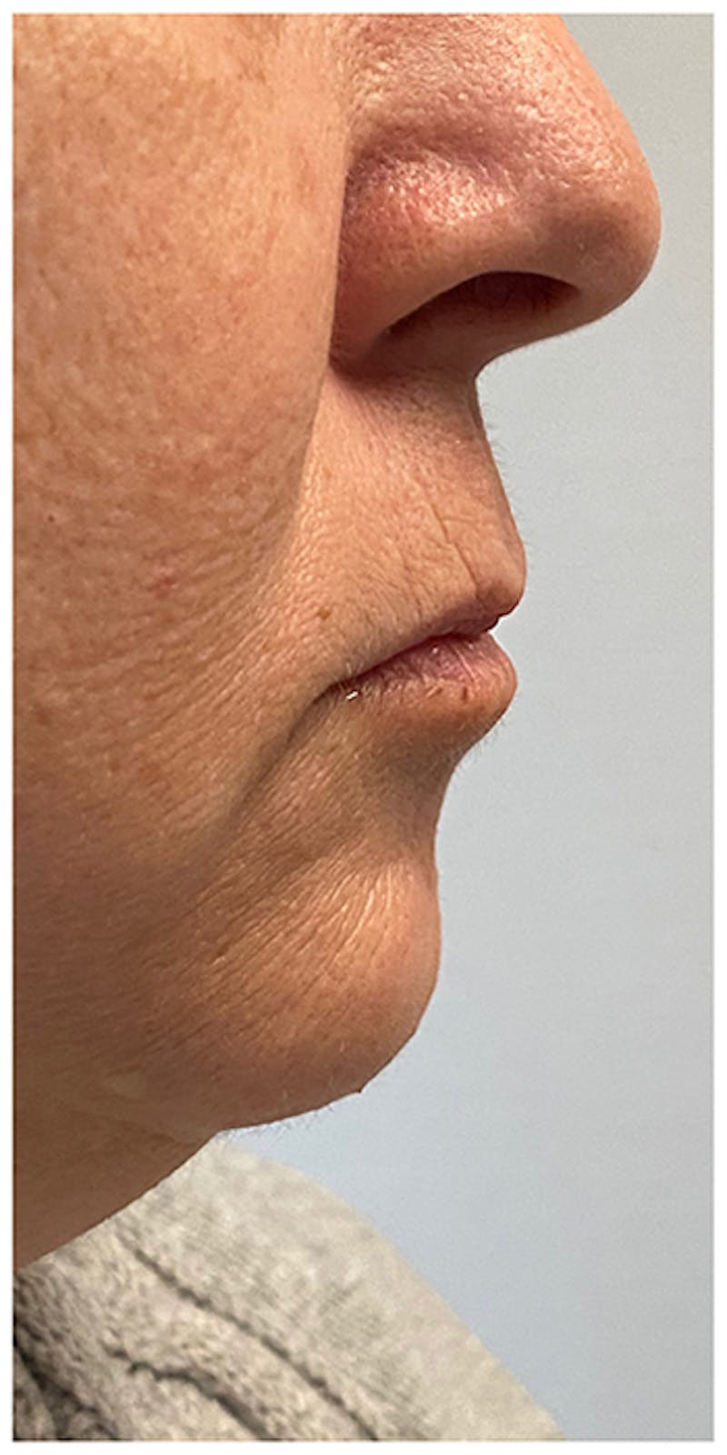Dermal Fillers Before & After Gallery - Patient 133024098 - Image 5