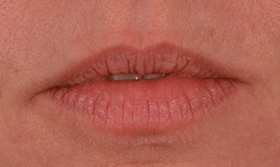 Lip Enhancement Before & After Gallery - Patient 133024086 - Image 1