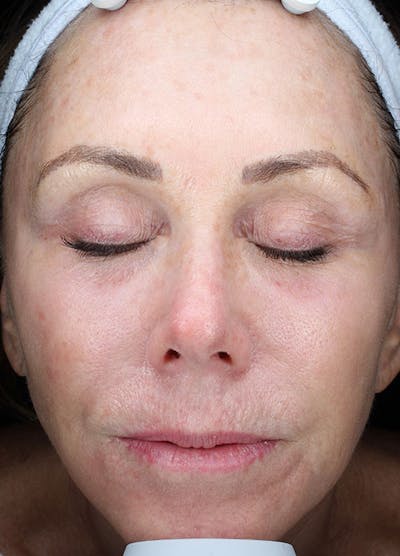 Halo Laser Before & After Gallery - Patient 133024088 - Image 2