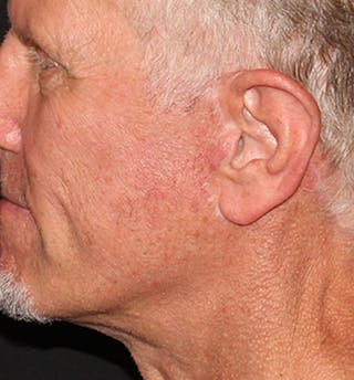 Facelift Scar Before & After Gallery - Patient 133024090 - Image 2