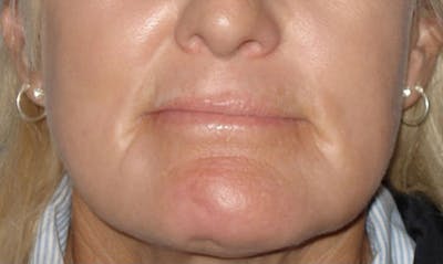 Laser Resurfacing Before & After Gallery - Patient 133024087 - Image 2