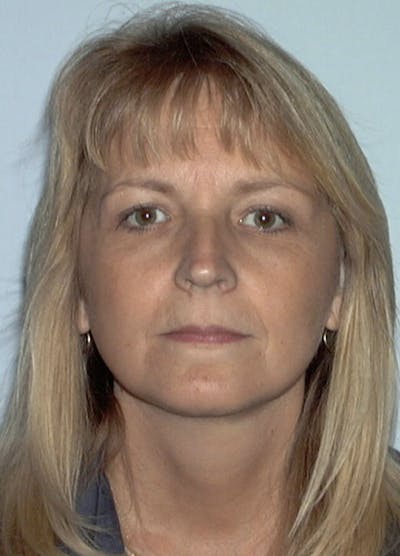 Facelift & Necklift Before & After Gallery - Patient 133024095 - Image 2