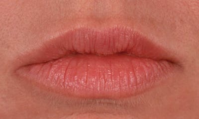 Lip Enhancement Before & After Gallery - Patient 133024086 - Image 2